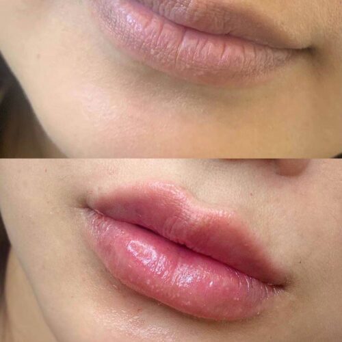 Cica Skin Care lip filler