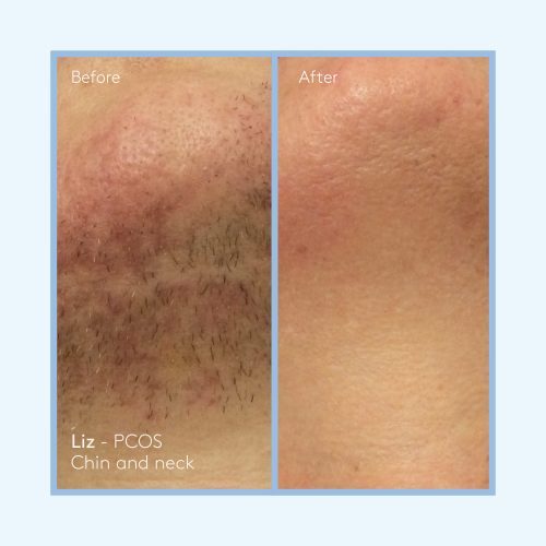 Permanence -Before and After - Liz 01