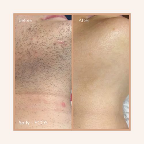 Permanence -Before and After - Sally